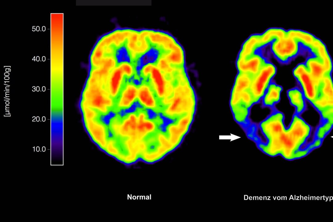 Antikörper Lecanemab: Wie er wirkt und wem er helfen kann - Haben die Amyloid-Plaques schon irreversible Schäden im Gehirn angerichtet, nützt ihre Entfernung nichts mehr. (Archivbild)