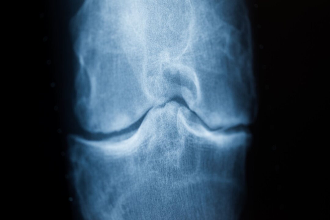 Diagnose Arthrose? Das können Sie nun selbst tun - Spätestens das Röntgenbild schafft Klarheit: Der Knorpel nutzt sich immer mehr ab. Im späteren Stadium einer Arthrose reibt Knochen direkt auf Knochen.