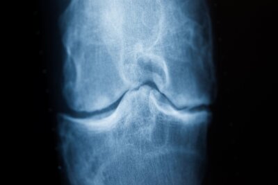 Diagnose Arthrose? Das können Sie nun selbst tun - Spätestens das Röntgenbild schafft Klarheit: Der Knorpel nutzt sich immer mehr ab. Im späteren Stadium einer Arthrose reibt Knochen direkt auf Knochen.