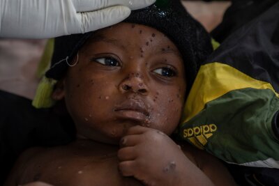 Erster Fall der neuen Mpox-Variante in Deutschland - Ein an Mpox erkrankter zweijähriger Junge liegt in einem Krankenhaus in Kamituga im Osten des Kongo.