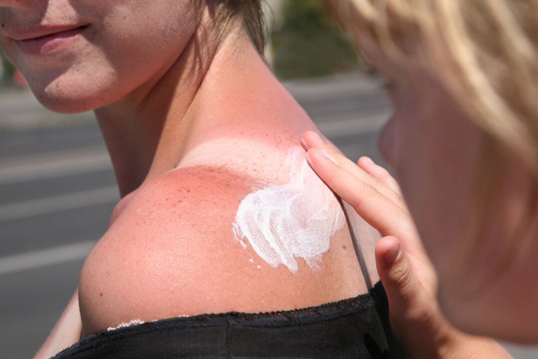 Von Quark bis Tee: Mit Hausmitteln gegen den Sonnenbrand - Zu viel Sonne auf die Schultern bekommen? Dann helfen Kühlung und eine beruhigende Hautpflege.