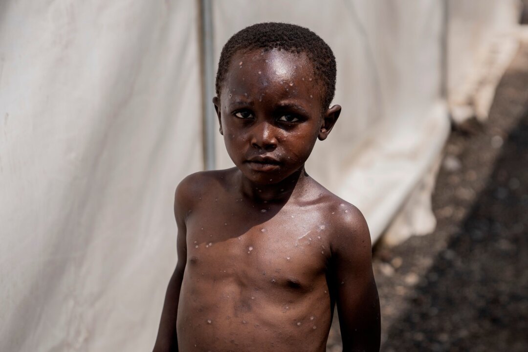 WHO: Mpox-Ausbruch weiter gesundheitliche Notlage - Für Kinder und immungeschwächte Menschen kann die Krankheit tödlich sein. (Archivbild)